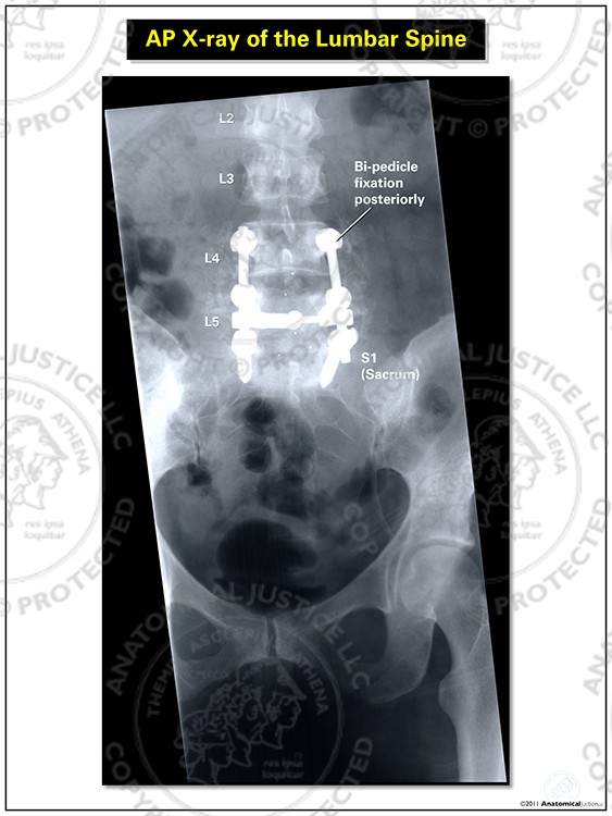 AP X-Ray of the Lumbar Spine