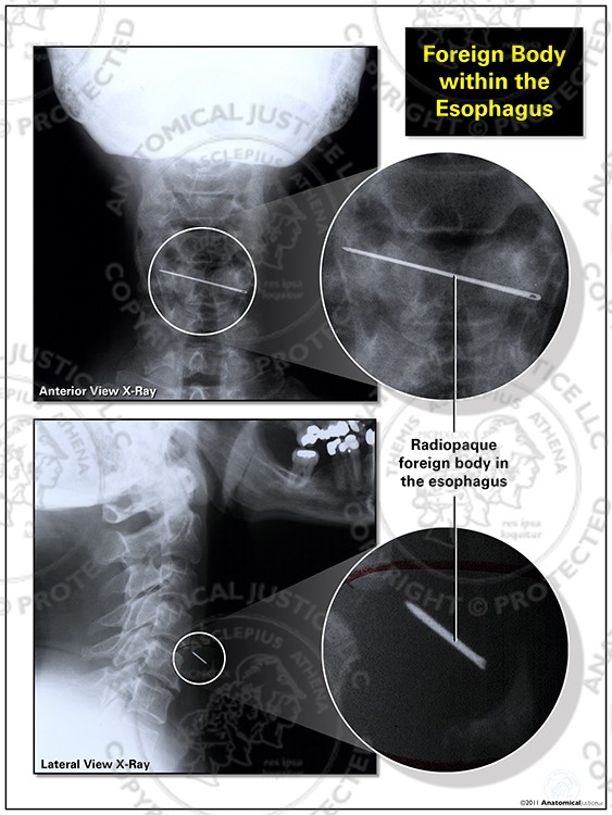 Foreign Body within the Esophagus