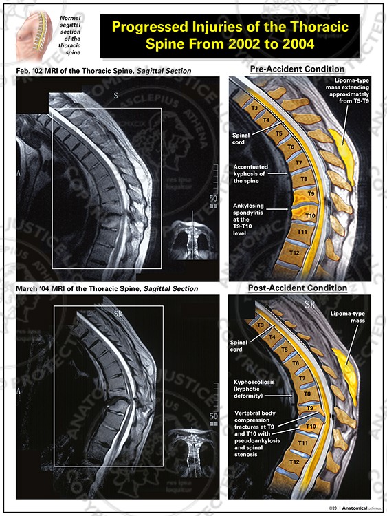Progressed Injuries of the Thoracic Spine from 2002 – 2004