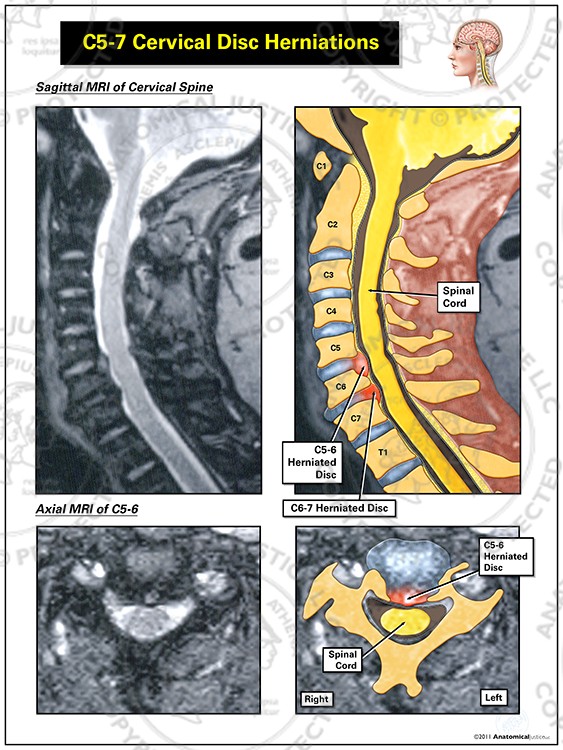 C5-7 Cervical Disc Herniations