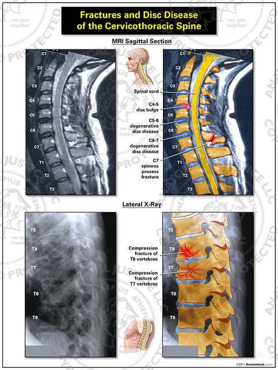 Fractures and Disc Disease of the Cervicothoracic Spine