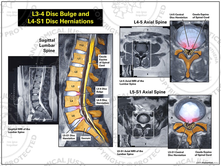 L3-4 Disc Bulge and L4-S1 Disc Herniations