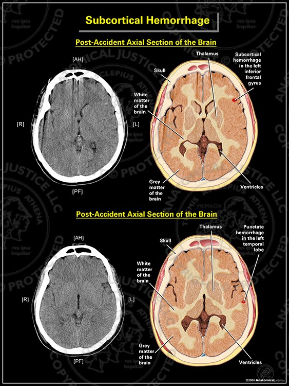 Subcortical Hemorrhage