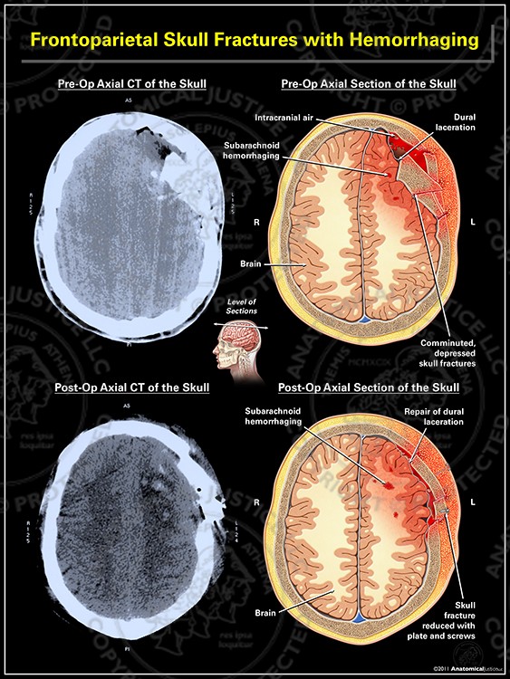 Frontoparietal Skull Fractures with Hemorrhaging