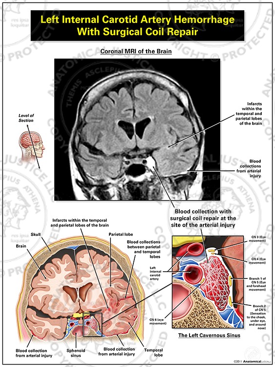 Left Internal Carotid Artery Hemorrhage with Surgical Coil Repair