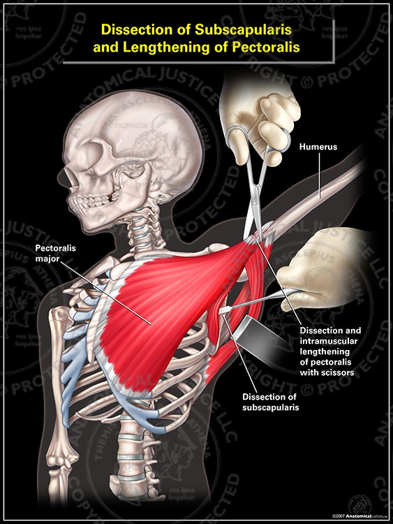 Dissection of Subscapularis and Lengthening of Pectoralis
