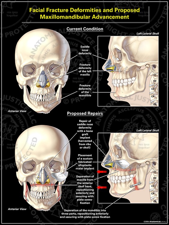 Facial Fracture Deformities and Proposed Maxillomandibular Advancement