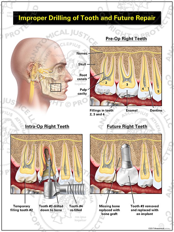 Improper Drilling of Tooth and Future Repair