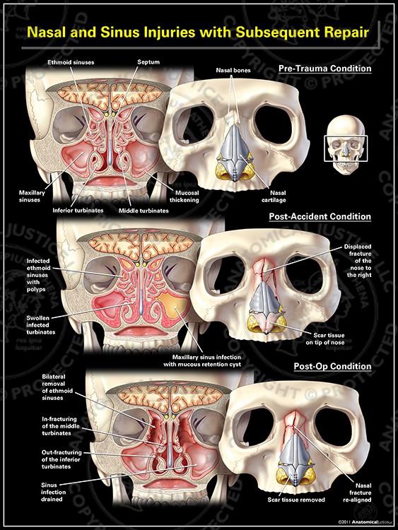 Nasal Sinus Injuries with Subsequent Repair