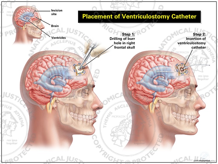 Placement of Ventriculostomy Catheter