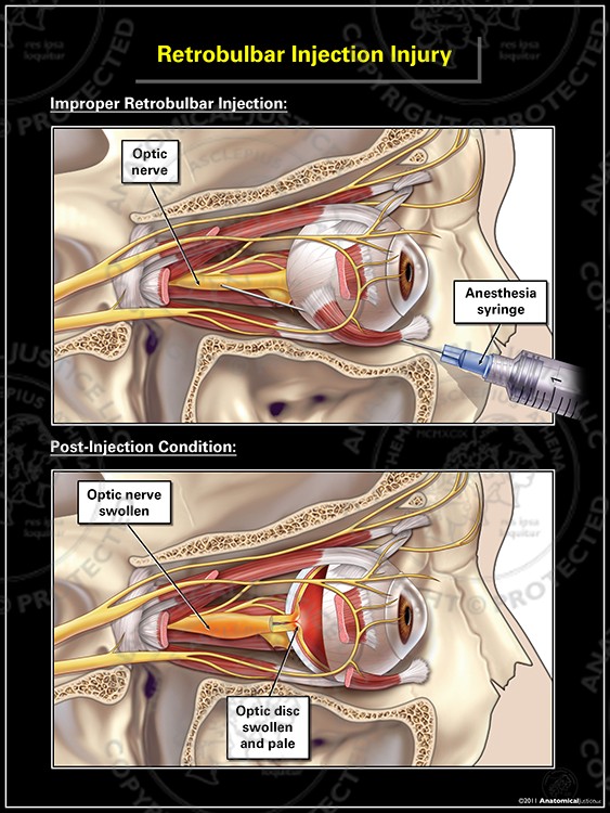 Retrobulbar Injection Injury