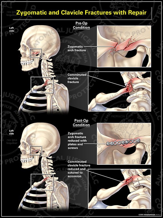 Zygomatic and Clavicle Fractures with Repair