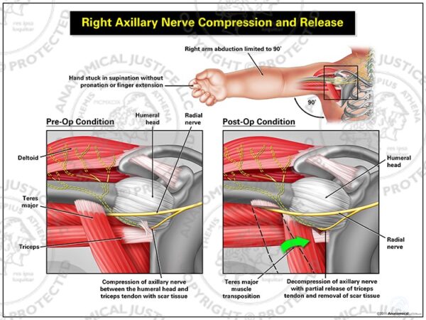 Right Axillary Nerve Compression and Release – Custom Medical ...