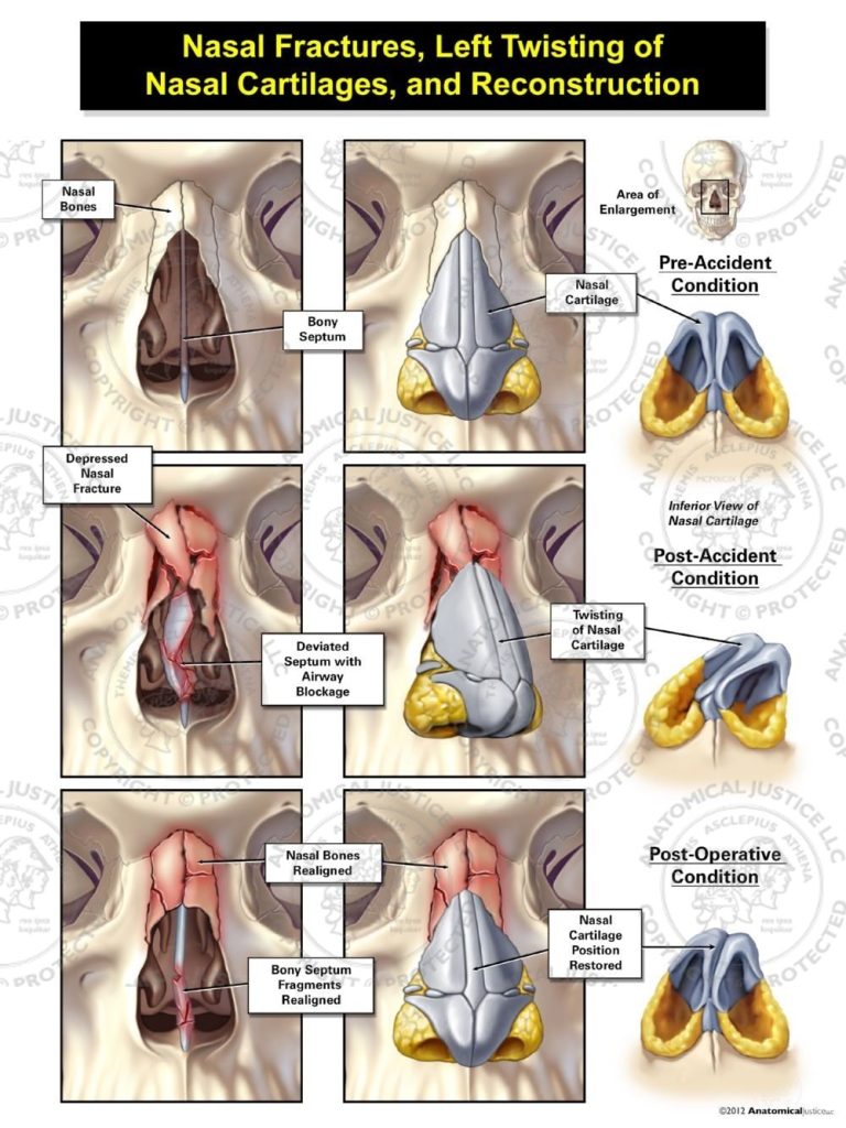 broken nose - Medical Legal Illustrations & Trial Graphics