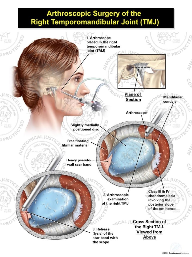 Male Arthroscopic Surgery of the Right Temporomandibular Joint