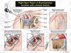 Right Open Repair of Supraspinatus Avulsion with a Suture Anchor