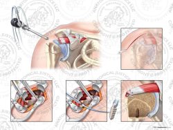 Right Open Repair of Supraspinatus Avulsion with a Suture Anchor – No Text