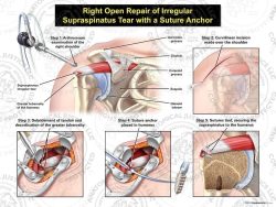 Right Open Repair of Irregular Supraspinatus Tear with a Suture Anchor