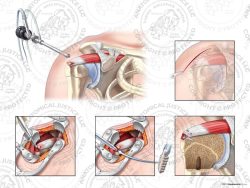 Right Open Repair of Irregular Supraspinatus Tear with a Suture Anchor – No Text