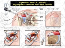Right Open Repair of Crescent Supraspinatus Tear with Two Suture Anchors