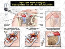 Right Open Repair of Irregular Supraspinatus Tear with Three Suture Anchors