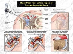 Right Open Repair of Supraspinatus Avulsion with Four Sutures