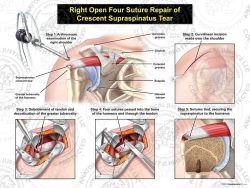 Right Open Repair of Irregular Supraspinatus Tear with Four Sutures