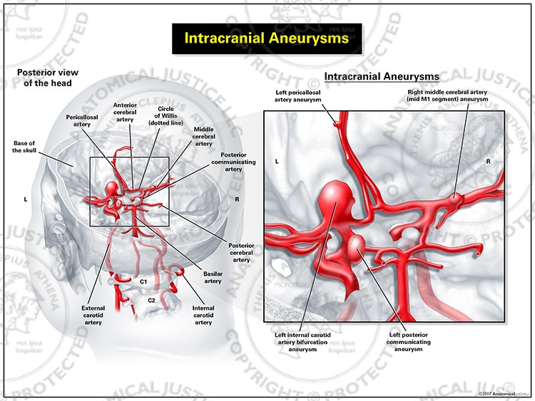Intracranial Aneurysms