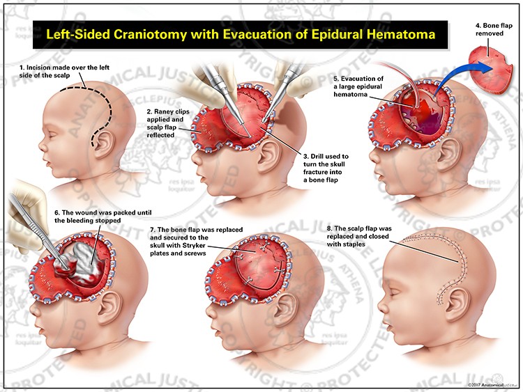 Left-Sided Pediatric Craniotomy and Evacuation of Hematoma