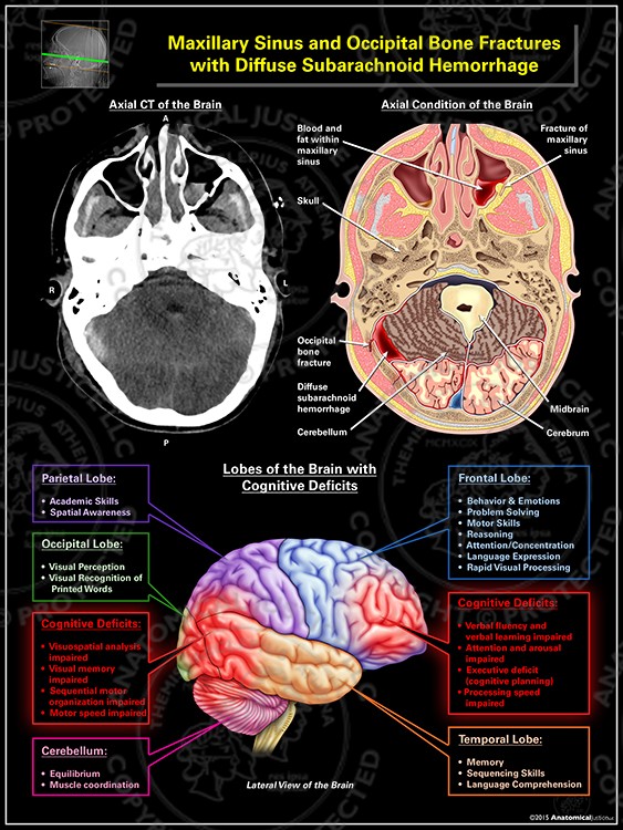 Maxillary Sinus and Occipital Bone Fractures with Diffuse Subarachnoid Hemorrhage