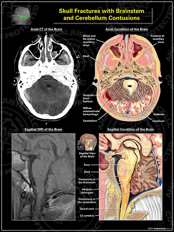 Skull Fractures and Brainstem, Cerebellum Contusions