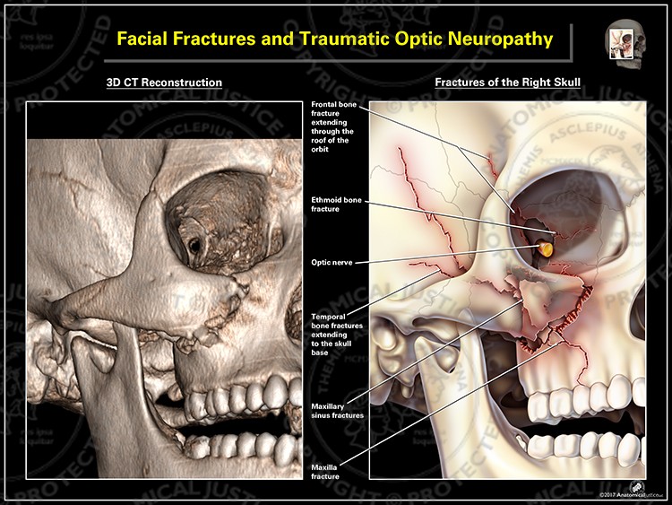 Facial Fractures and Traumatic Optic Neuropathy