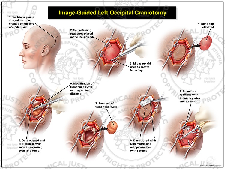 Image-Guided Left Occipital Craniotomy
