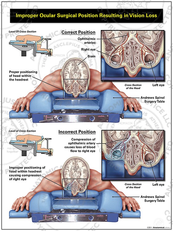Improper Ocular Surgical Positioning with Vision Loss