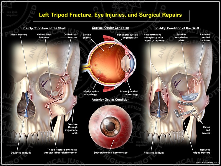 Left Tripod Fracture, Eye Injuries, and Surgical Repairs