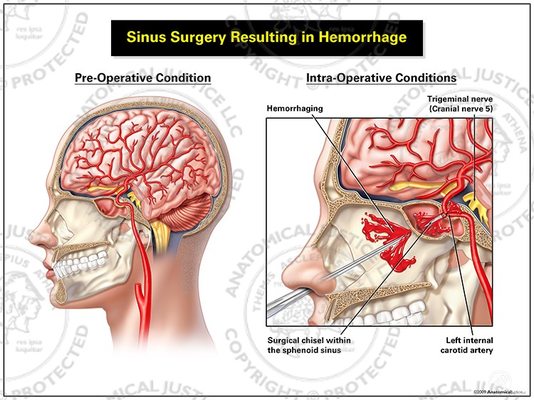 Sinus Surgery Resulting in Hemorrhage