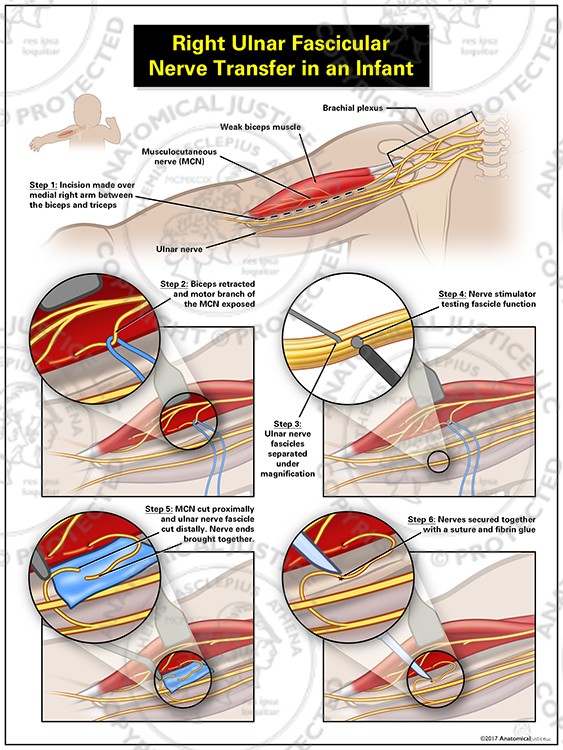Right Ulnar Fascicular Nerve Transfer in an Infant