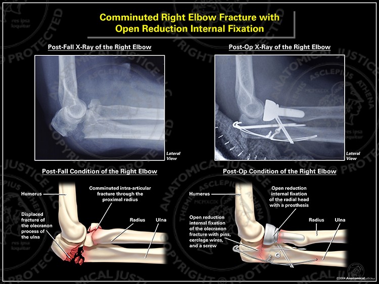 Comminuted Right Elbow Fracture with Open Reduction Internal Fixation
