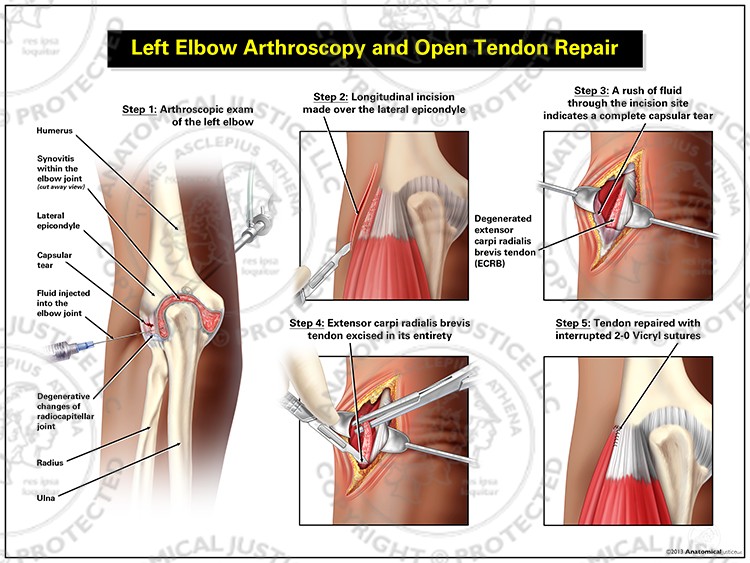 Left Elbow Arthroscopy and Open Tendon Repair