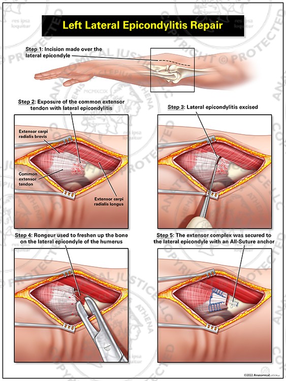 Left Lateral Epicondylitis Repair