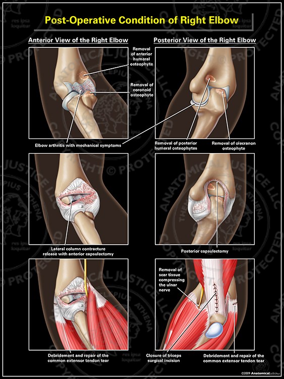 Post-Operative Condition of Right Elbow