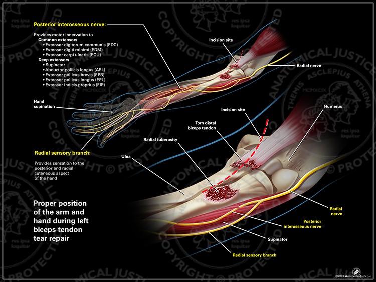 Proper vs. Improper Arm and Hand Position During Left Biceps Tendon Repair