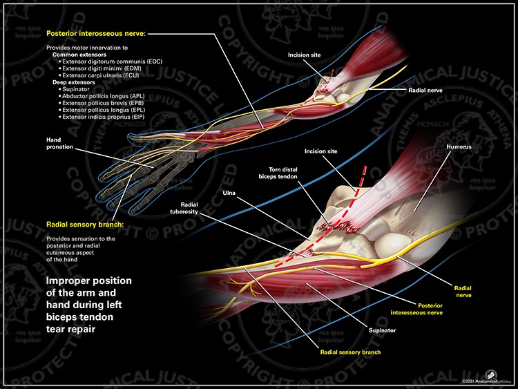 The left radial nerve is safely not under the incision site. An illustration of the forearm in the incorrect, prone position is on the top half of the exhibit, and an enlargement of the incision site over the elbow, showing the left radial nerve, is below.