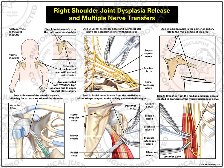 Right Shoulder Joint Dysplasia Release and Multiple Nerve Transfers