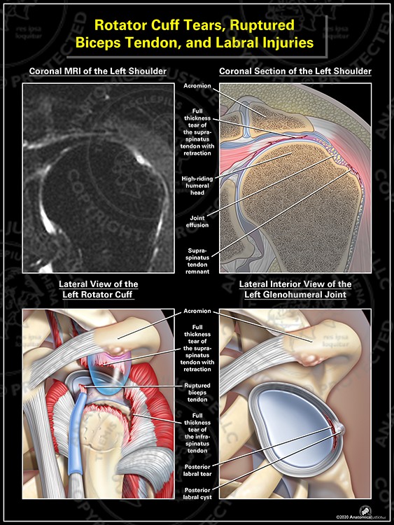 Rotator Cuff Tears, Ruptured Biceps Tendon, and Labral Injuries
