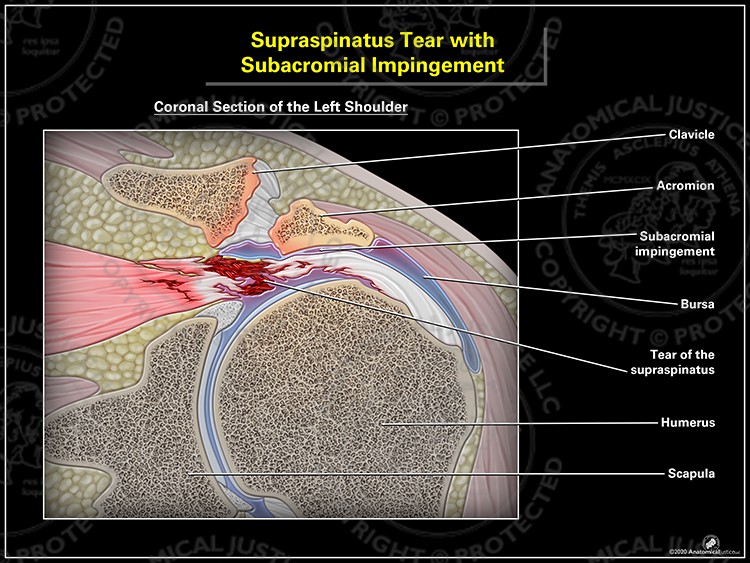 Supraspinatus Tear with Subacromial Impingement