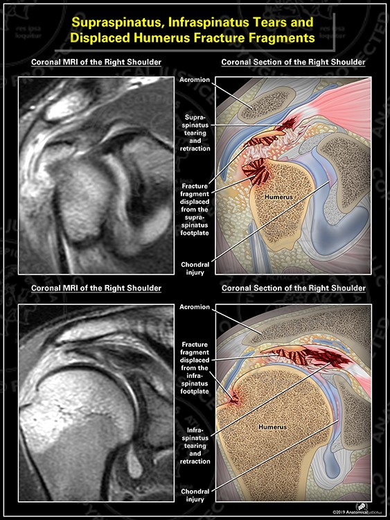Supraspinatus, Infraspinatus Tears and Displaced Humerus Fracture Fragments