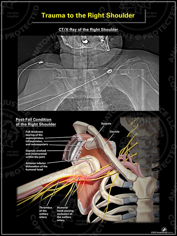 Trauma to the Right Shoulder