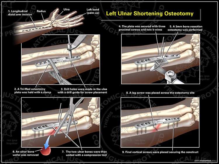 Left Ulnar Shortening Osteotomy