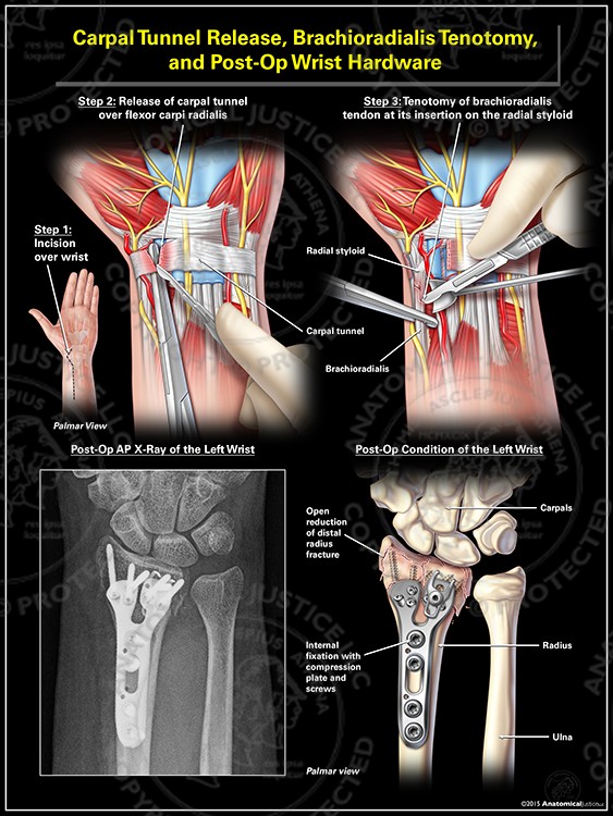 Carpal Tunnel Release, Brachioradialis Tenotomy, and Post-Op Wrist Hardware